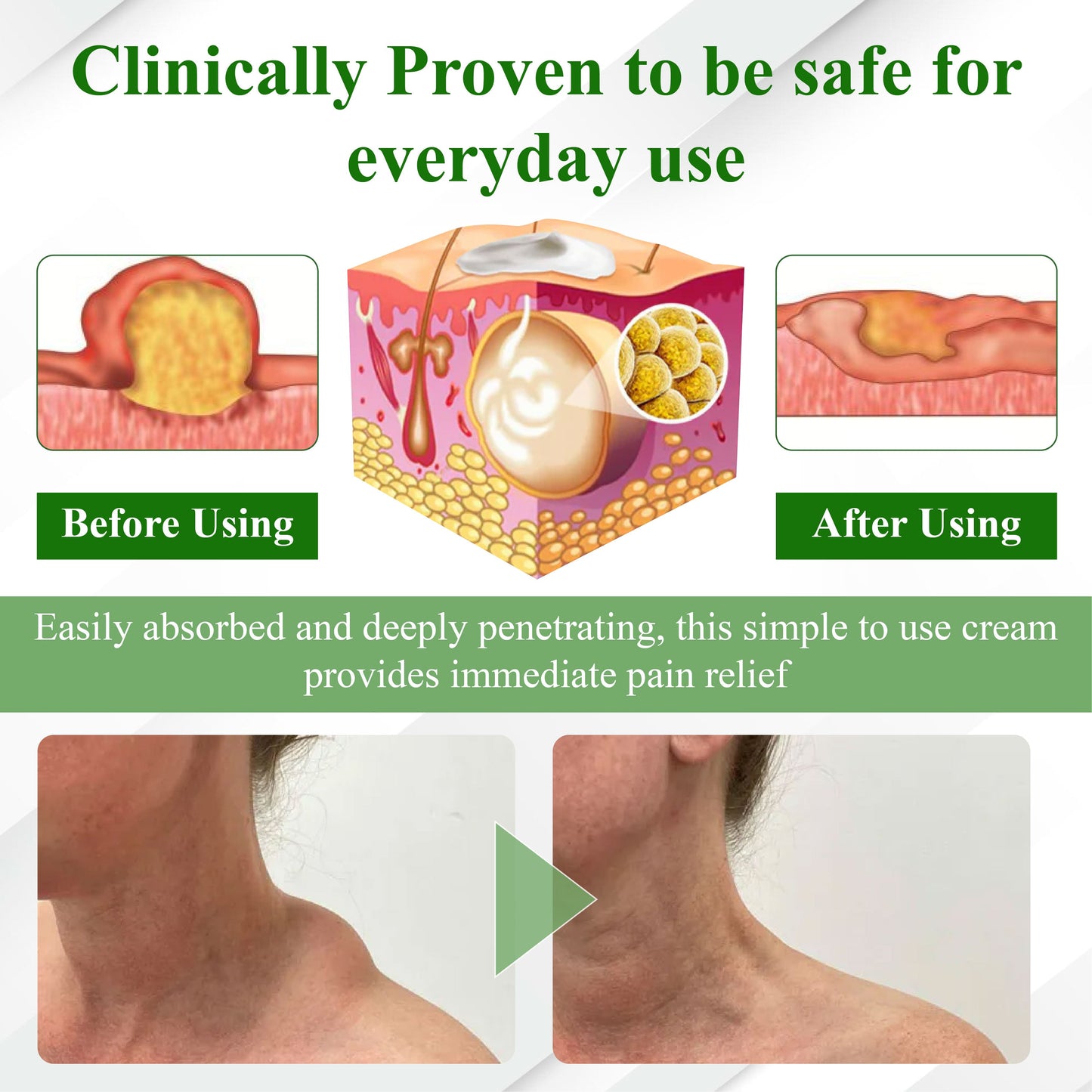 Natravor™ LipoClear Sparganium Rhizome Relief Cream