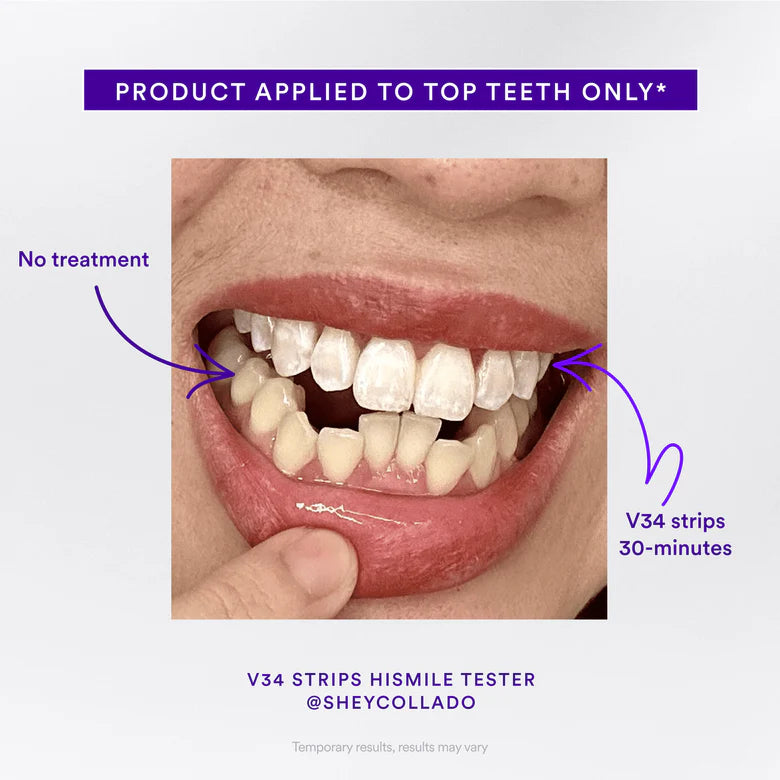 🦷Natravor™ V34 Whitening Strips| Instant whitening⭐