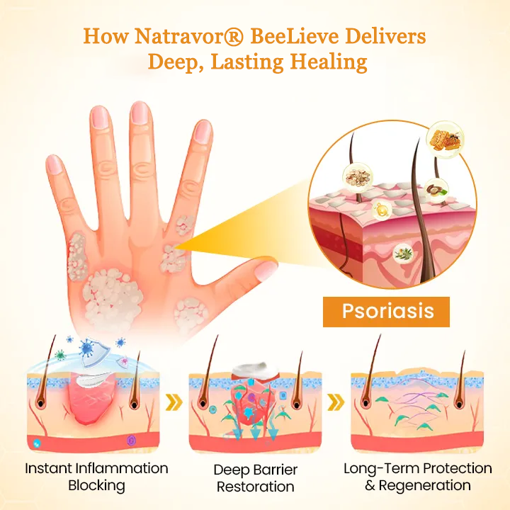Natravor® BeeLieve Psoriasis Skin Care